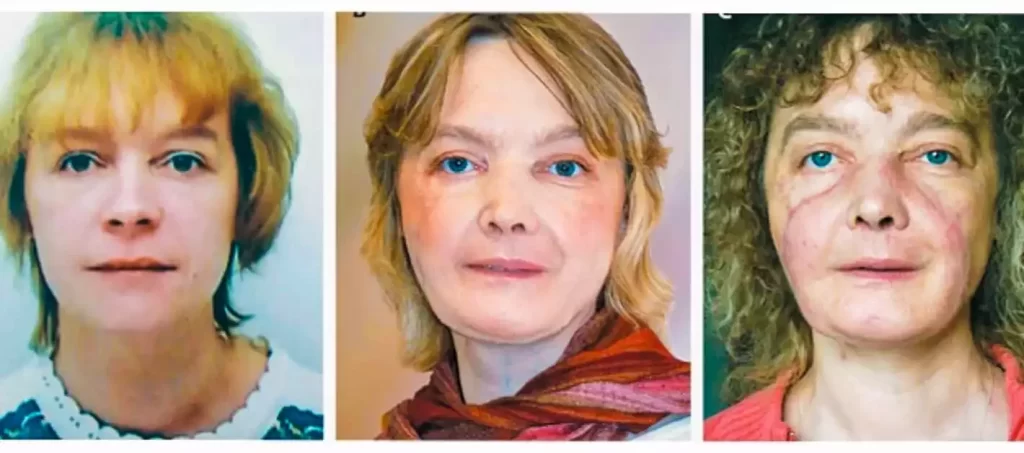 Face Transplants